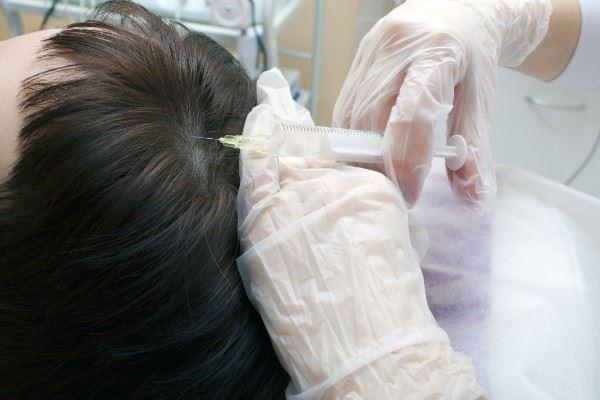 Мезотерапия позволяет справиться с облысением и вылечить перхоть
