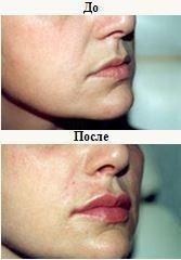 restylane injection2