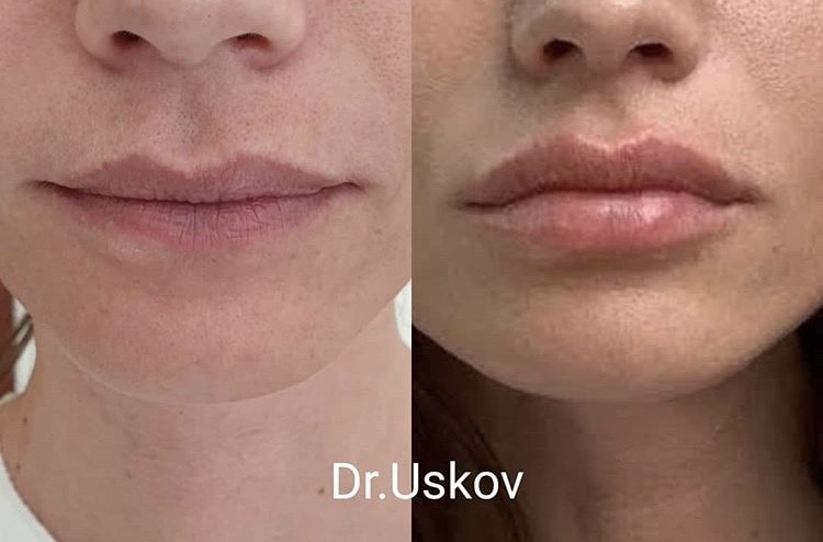 Контурная_пластика_губ_1.jpg